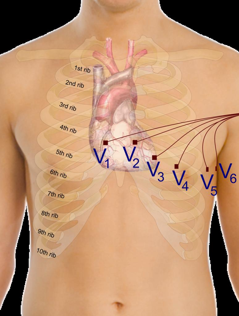 Q12 胸部単極誘導 Wikipedia (英語版) より V1 と V6 では QRS 群の形が大きく異なる