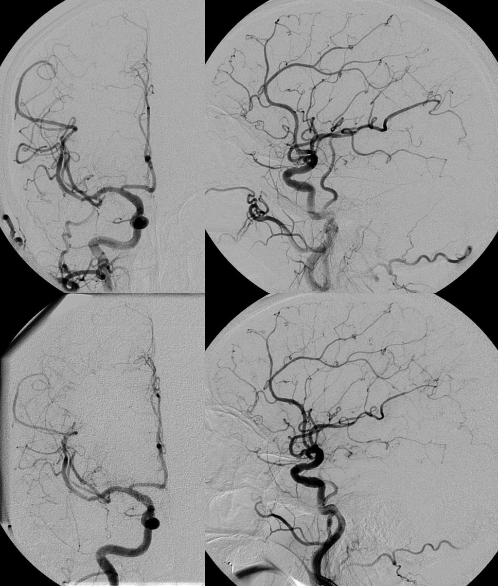 C D Fig. 3 Ａ Ｂ The postprocedural right carotid angiograms show absence of stenosis or filling defects in the intracranial arteries.