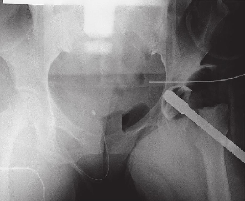 merican 最初である このガイドラインは第 6 版米国胸部 cademy of Orthopaedic Surgeons から人工関節置換 医学会 P: merican ollege of hest Physicians 術後の症候性