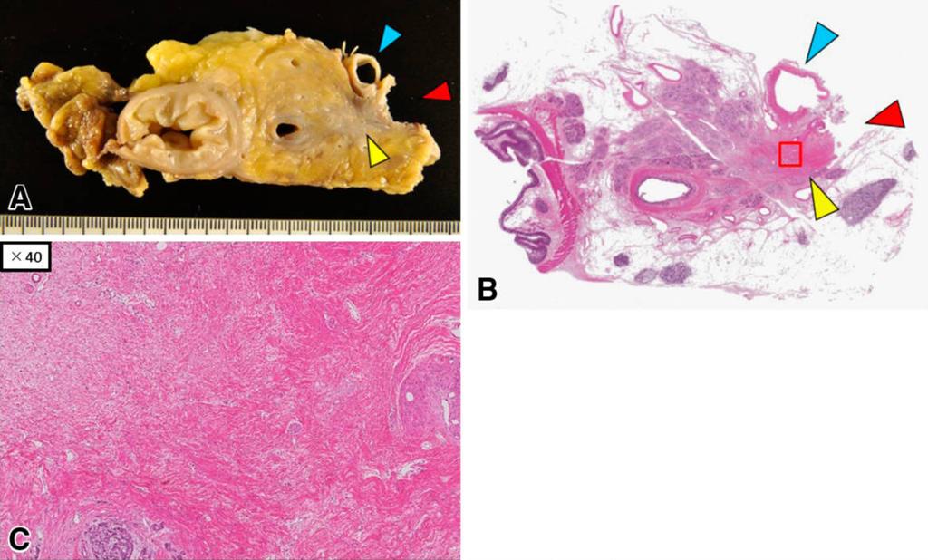 Histopathological examination revealed that the tumor cell have disappeared and carcinoma cells had been replaced by fibrosis with inflammatory cells in the pancreatic parenchyma (yellow arrowhead),