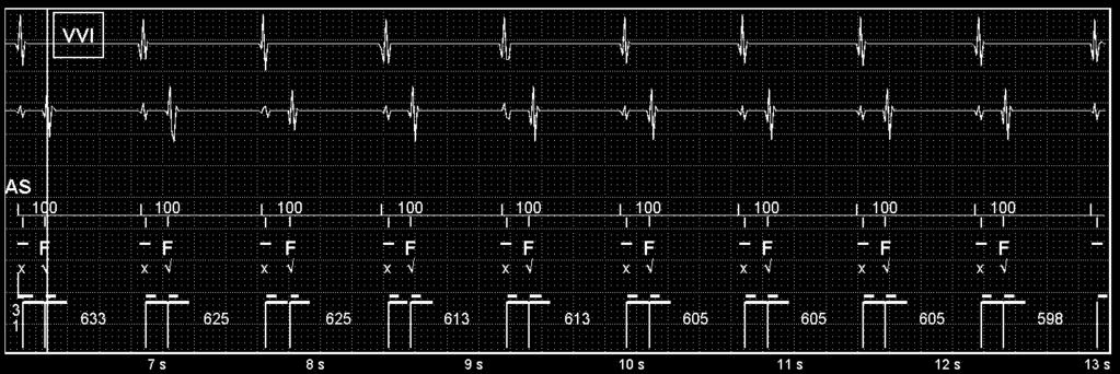 解説 1 つの心房イベントに対して 2 つの心室イベントが確認できる 心房波とほぼ同じタイミングでセンシングされる心室波と心房波から約 180ms でセンシングされる心室波が見られる 解説 VF として検出 ( ) され 充電中の TP が実施 ( ) され さらに充電され (