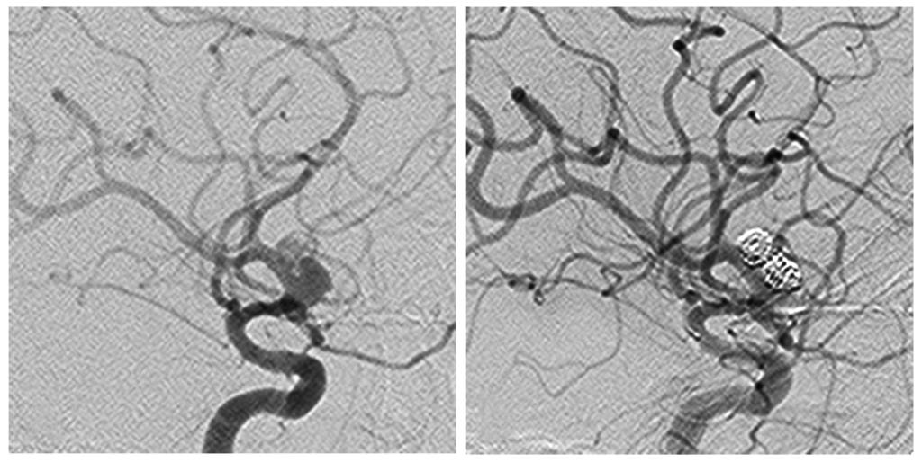 fourth branch of this aorta ( ④ )(C). Fig. 3 The preoperative working angle view of digital subtraction angiography of the left internal carotid artery angiography.