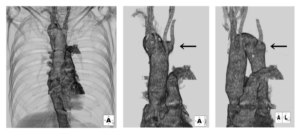 C Fig. 5 ntero-posterior view (, ) and left-anterior-oblique view (C) of 3D-CT volume rendering image show the rightsided aortic arch. rrows show the aortic diverticulum (Kommerell's diverticulum).