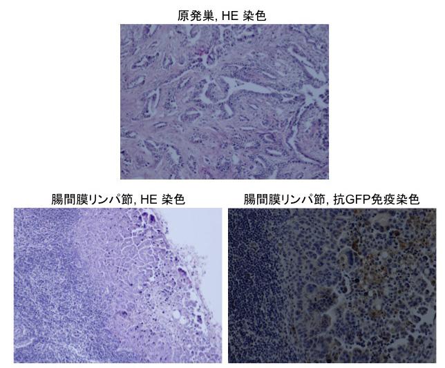 移植後約 10 週間で同マウスの肺 腸間膜リ ンパ節に生じた転移巣の写真 図 2 および 組織像 図 3 を示す 表 1. 同定された転移抑制遺伝子候補 図 2.