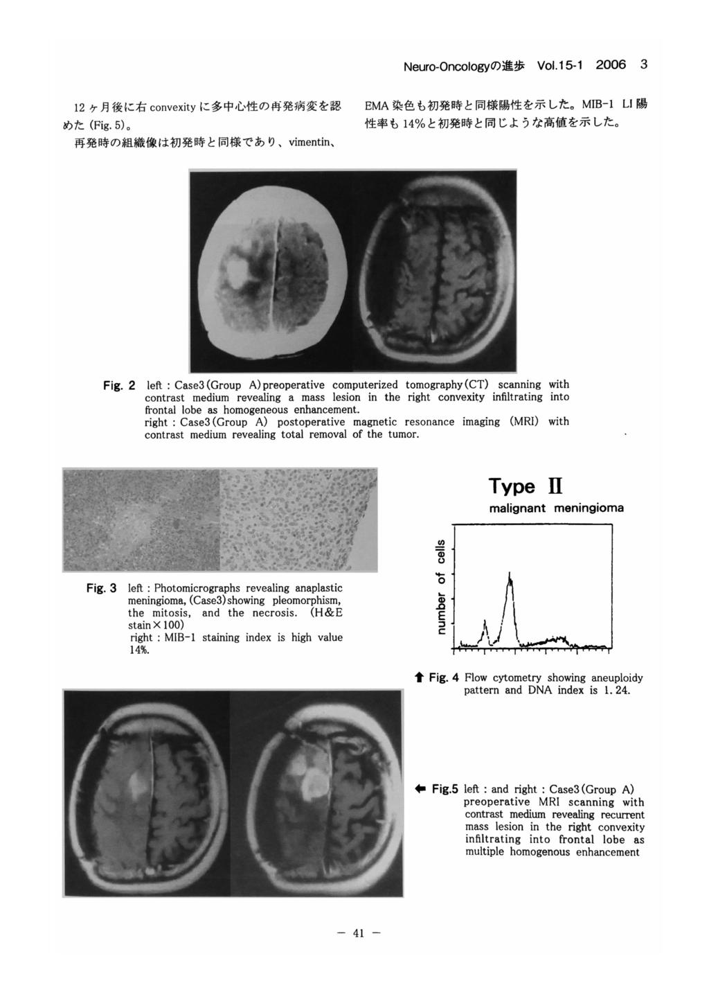 Fig. 2 left : Case3 (Group A) preoperative computerized tomography (CT) scanning with contrast medium revealing a mass lesion in the right convexity infiltrating into frontal lobe as homogeneous