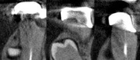 研究の目的 CBCT を用いた高品質の画像診断は 歯内療法において不可欠な場面も多い CBCT の有用性と 撮像時の症例選択の理由を明確にすることで その使用が必要最小限となり被爆線量を抑えられる また 正確な画像診断は 得られた画像の最大限の有効活用を可能とする 3.