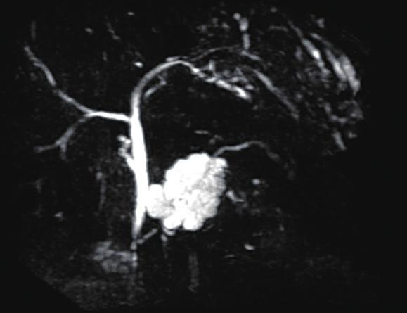 langiopancreatography: ERCP かな壁在結節も認めず Fig. 4 嚢胞の被膜 狭窄や途絶の像は認めず 膵頭部の膵管は嚢 上皮細胞は 小型立方状で明るい胞体を示し C Fig. 1.
