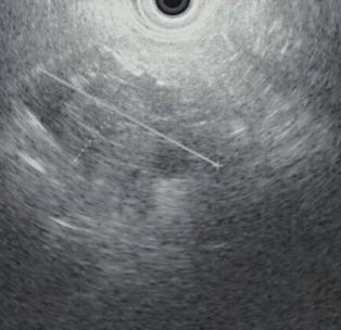 画像上拡大傾向を示した膵漿液性嚢胞腺腫の 1 例 類円形の核を入れる たことが分かる Fig.
