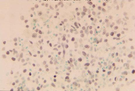 肺小細胞癌腫瘍捺印細胞診標本での p53 免疫染色 (DO7) を提示する ( 図 10 11) 染色条件は 1 次抗体室温 2 時間 2 次抗体およびストレプトアビジンは 30 分である