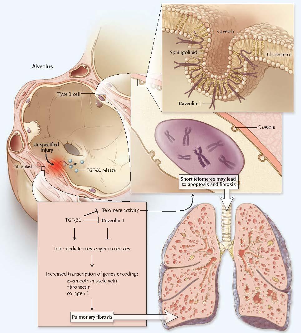 肺胞小窩 スフィンゴ脂質 コレステロール 肺胞 Ⅰ 型肺胞上皮 カベオリン -1 肺胞小窩 傷害 TGFβ1 放出 テロメアが短いとアポトーシスや線維化につながる テロメア活性 カベオリン -1 伝達分子の介在 以下の分子をコードする遺伝子の転写の亢進 肺線維症 カベオリン -1 テロメア そして肺線維症は TGF-β1 の刺激を受けて