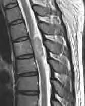 41 歳 女性背部痛 下肢のしびれ 脱力近医で下部胸椎 ~ 腰椎 MRI
