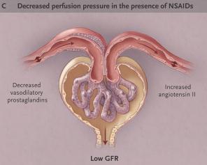 潅流圧が下がった輸入細動脈収縮 (NSAIDs) 輸出細動脈収縮糸球体内圧低下
