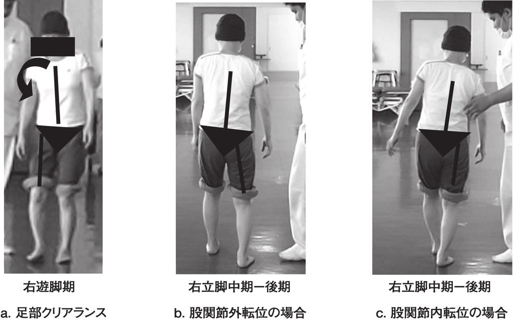 124 實光遼, 他 1 a. 治療前は右遊脚期での右足部クリアランス低下による右後方への転倒傾向を認めた b. 右立脚期を通して右股関節外転位であり 右立脚中期から後期では急激な右膝関節伸展が生じ 右股関節屈曲し体幹の軽度前傾が生じた 続く 右立脚後期に右股関節外転し体幹の右側方傾斜がみられ右側方への不安定性がみられた場面である c.