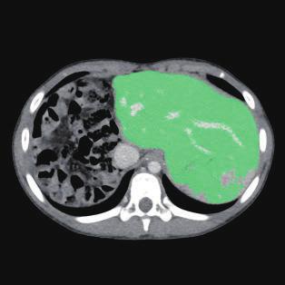 There is no application in 3DWS for the segmentation of the spleen.