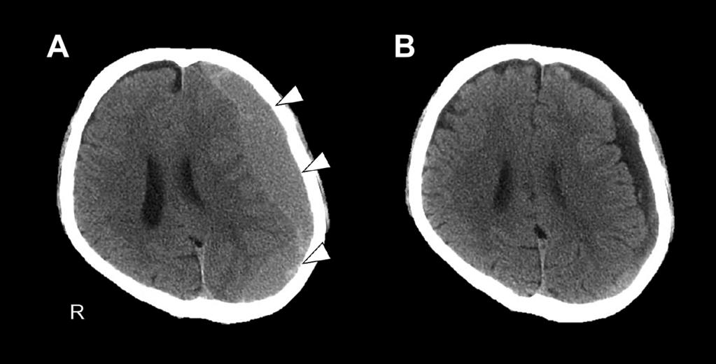 超急性期脳梗塞と鑑別を要したてんかん性発作 61:167 Fig. 1 Axial CT images before and after operation. A: Preoperative axial CT image showing left lateralized chronic subdural hematoma (arrowheads).