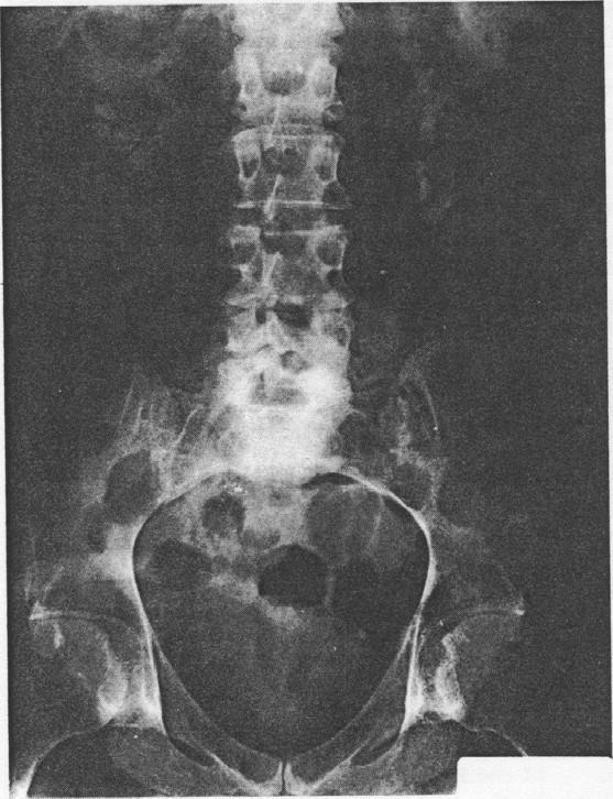 BODILY RESPONSES TO IMMOBILIZATION 979 FIGURE 52-4. Radiograph of the abdomen of a quadriplegic person eight months after a cervical spinal cord injury. The patient had been inactive most of the time.