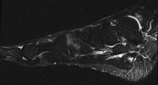 骨 挫 傷 左 内 側 楔 状 骨 にはT1 強 調 像 で 低 信 号 脂 肪 抑 制 併 用 T2 強 調 像 で 高