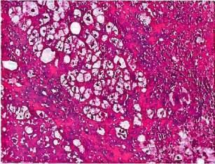 NASH(ナッシュ)の 肝 生 検 所 見 線 維 に 囲 まれる 脂 肪 で 風 船 様 に 腫 大 した 肝 細 胞 が 認