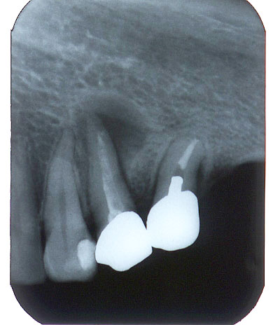 図３ 症例番号１９ 下顎左側第一小臼歯に対してシアノアクリレートセメントにより逆根管