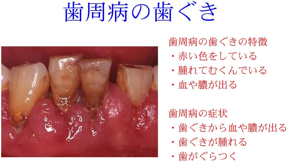 膿 が 出 る 歯 周 病 の 症 状 歯 ぐきから 血