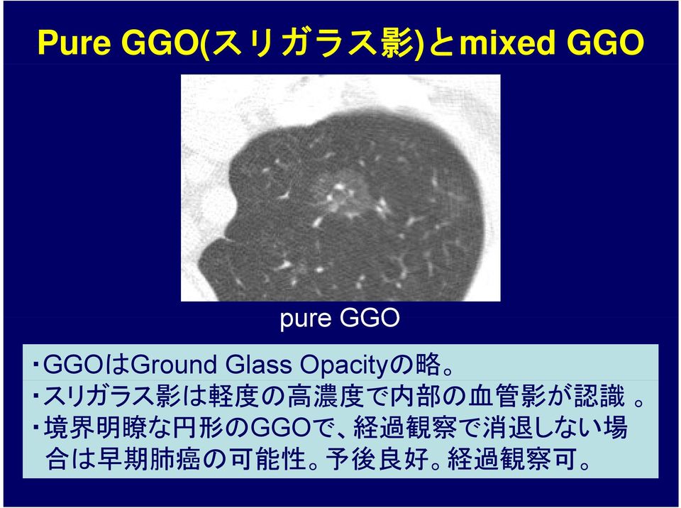 濃 度 で 内 部 の 血 管 影 が 認 識 境 界 明 瞭 な 円 形 のGGOで 経