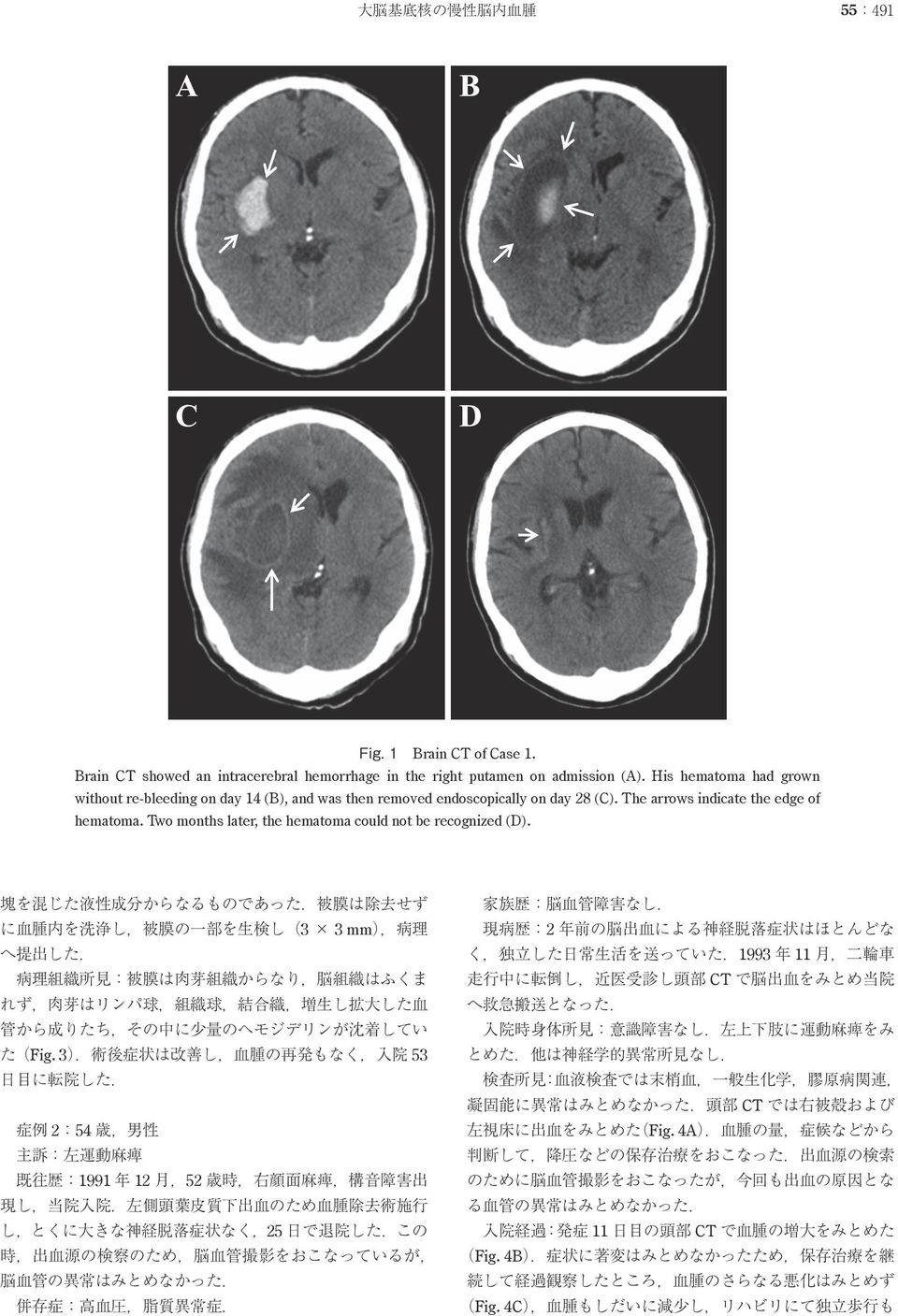 Two months later, the hematoma could not be recognized (D). 塊 を 混 じた 液 性 成 分 からなるものであった. 被 膜 は 除 去 せず に 血 腫 内 を 洗 浄 し, 被 膜 の 一 部 を 生 検 し(3 3 mm), 病 理 へ 提 出 した.