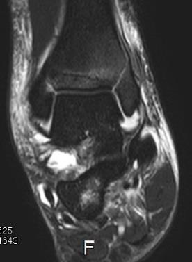 足関節 MRI 基本ルーチン +α T2WI SAG T1WI SAG