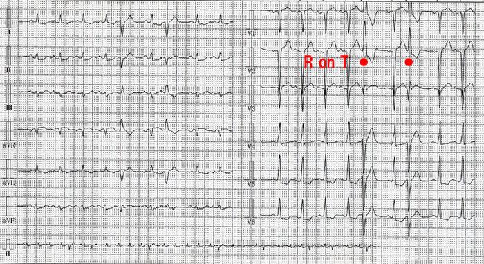 R on T 先行する洞性心拍のT 波に重なるようにして生じた心室性期外収縮を R on T といいます 急性心筋梗塞や重症の心筋障害が存在するときに R on T を生ずると心室頻拍や心室細動を発現させる危険があります 心室頻拍幅広く変形したQRS