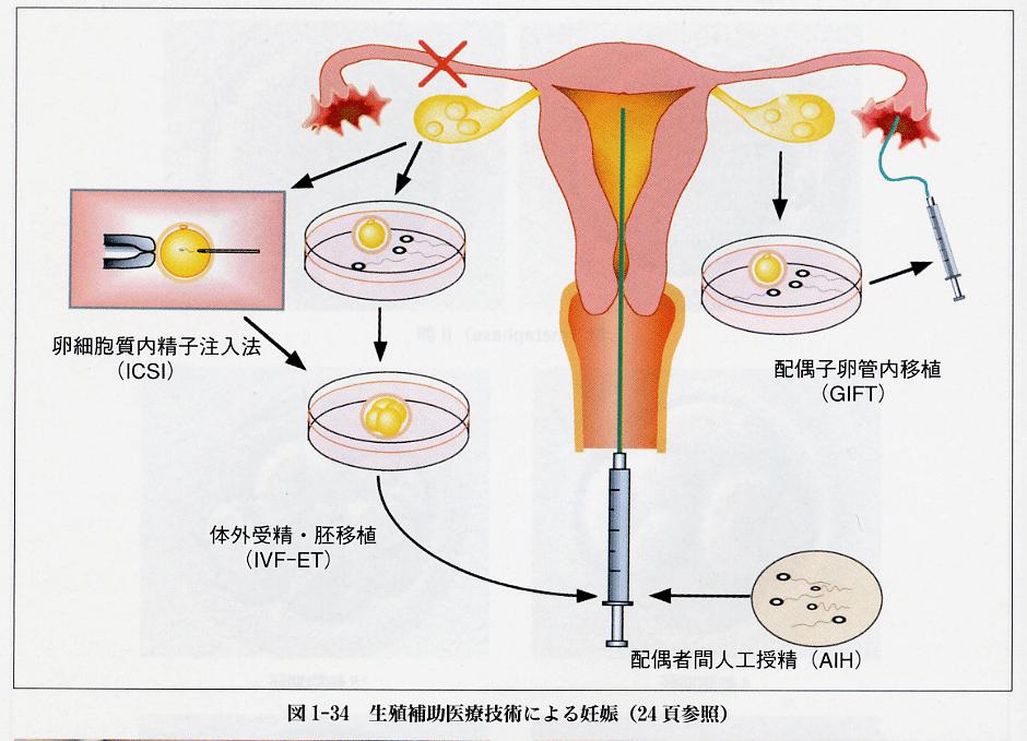 不妊症治療の主役 卵細胞質内精子注入法 (ICSI) 初成功はベルギーで 1992 年日本では 1993 年兵庫医科大学では 1995 年 体外受精 胚移植