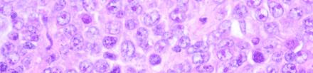 抗原を認識 ほとんどのB 細胞性リンパ腫ではCD20 抗原が発現しており しかも B 細胞以外の細胞には発現していないため