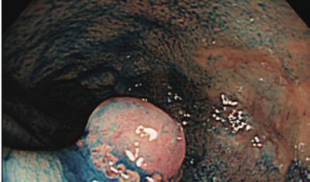 腫瘍径 10mm 以上 の側方発育を主体とした表面隆起型腫瘍は LST Laterally