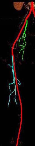 骨盤 ~ 膝動脈 腹部大動脈 abdominal aorta 総腸骨動脈 common iliac artery 外腸骨動脈 external iliac artery 内腸骨動脈 internal iliac artery 大腿動脈 femoral