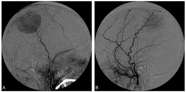 Cerebral angiography showed a tumor stain feeding from the right superficial temporal artery (A) as well as the left middle meningeal artery (B).