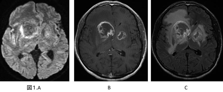 図 1. 意識障害の進行で来院した AIDS 関連 PCNSL の 26 歳男性症例 A: 拡散強調画像,B:Gd 造影 T1 強調画像,C:Gd 造影 FLAIR