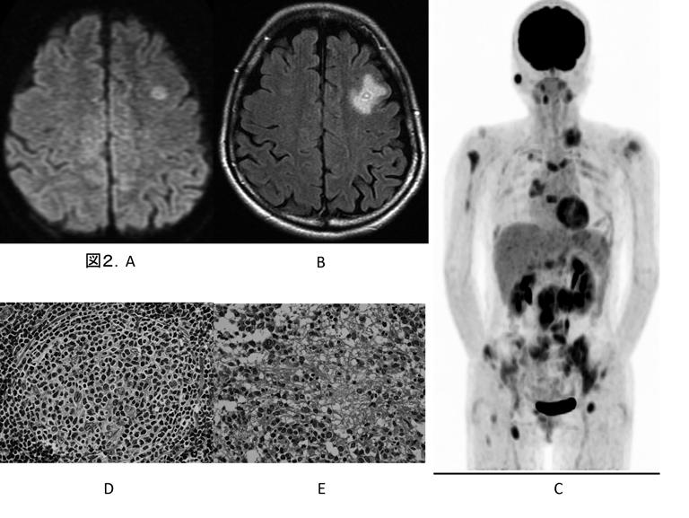 図 2. 全身性悪性リンパ腫の脳転移を生じた 63 歳女性症例 A: 拡散強調画像 B:Gd 造影 FLAIR 強調画像左前頭葉の小病変だが 周囲に比較的広範な浮腫を伴う C:FDG-PET