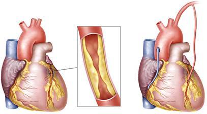 血管の閉塞に伴う症状が軽減される 心臓発作時に