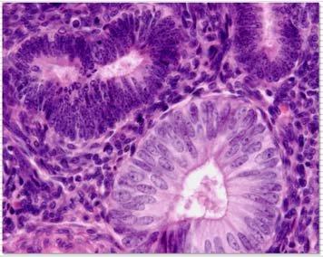 27 子宮内膜上皮内新生物 Endometrial Intraepithelial Neoplasia (EIN) Mutter GL