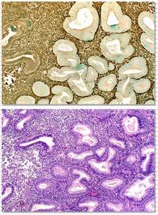 臨床的転帰の解析によって組織診断基準が確立されたモノクローナルな類内膜腺癌の前駆病変 絶対的な細胞 構造異型の程度よりも背景とのコントラスト (