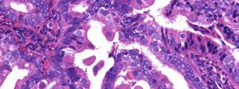 p53 p16 漿液性腺癌