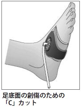 [ 足の創傷 ] 足の底面や踵の創傷には チューブの配置による余分な圧力がかからないようにするために ブリッジング法の使用が適しています これは 連結チューブを足背に配置するようにフォームを使用する方法です 創傷から離して連結チューブと接続するブリッジング法 1. 創傷部へフォームを置きます 2. 創傷周囲から足の甲にかけて V.A.C.