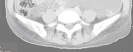 造影 CT にて腹膜が造影されている 中皮腫を示唆する 腹部画像