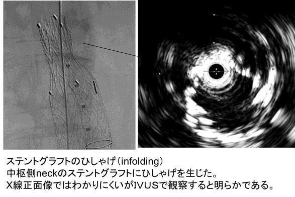(infolding) 十分に広がっていなかったりするとよくわかる そのため 血管造影装置のモニタにビルドインで IVUS の画像が見えるようになっている カテーテルは 9 フレンチを使用し ネック径を測るが IVUS と CT
