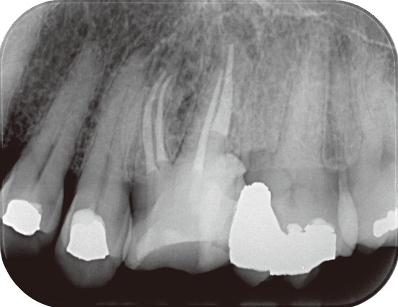 ファイル試適 1-5 根管拡大形成後 1-6 根管充填後 大臼歯における根管口探索には