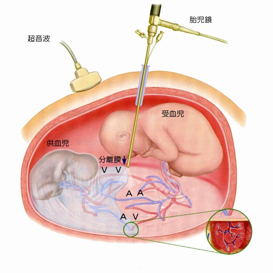 念がありますが 現状では多くのケースで手術が可能でした 分娩 ( 早産 + 新生児治療 ) にも備える必要があります 治療のながれ (1) 麻酔を施行した後 母体のおなかに約 5mm の皮膚切開を加え 受血児の羊水のスペースに金属の管 ( トロッカー ) を挿入します トロッカーより胎児鏡を挿入し 胎盤表面の吻合血管をレーザー光線にて凝固します 全ての吻合血管を凝固した後に