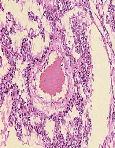 特徴ある多彩な組織像を呈する腫瘍 典型例 ( 内胚葉洞 ) では卵黄嚢を模倣した構造をつくる ときに腫瘍細胞が血管周囲に配列を示すシラー デュヴァル小体