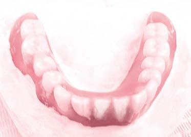 舌側は臼歯部では舌の筋圧によって辺縁封鎖されているが, 前歯部舌側の辺縁封鎖は,