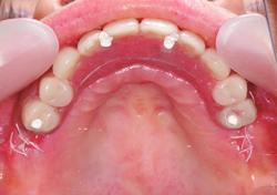 511 歯の喪失による心理学的側面を考えて最終補綴の設計を行う ンアンカードブリッジタイプの装着により 前歯部で食物を噛み切り 砕く動作が増加する つまり 噛める ということが 前歯部の咬み切る動作を増加することになるので プロビジョナルレストレーション時には特に破折の可能性がある カンチレバー ( 6 番相当部 ) の存在により 咬筋 側頭筋の活動が向上する一方