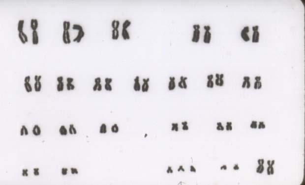 つあるとき トリソミーといいます 46,XY,+18,-21 : 染色体数は 46 性染色体は XY 18 番染色体が 1 個多く 21 番染色体が 1 個少ないです (3) 倍数体 69,XXX : 染色体数 69