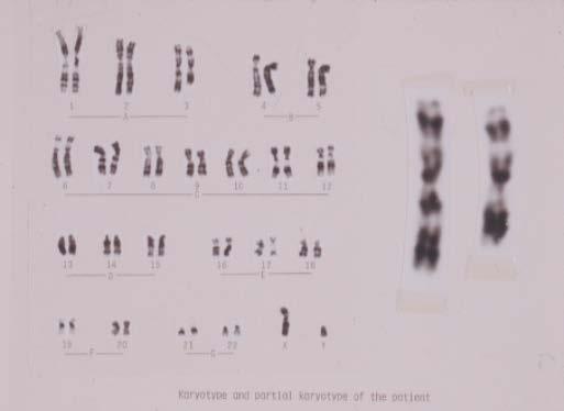 46,XY,del(3)(q12q21) 染色体数 46 性染色体 XY 3 番染色体の長腕 12 から 21 までが欠損しています b) 挿入 染色体の一部が切断し, 同じ染色体のある部分に そのまま入り込むア ) 正位挿入と 逆に入るイ