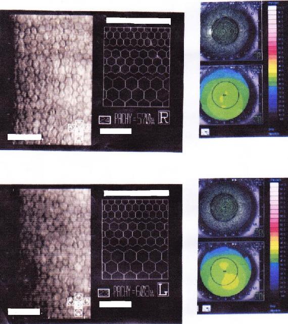 手術前の角膜内皮細胞と角膜形状の画像 手術当日のデータ :